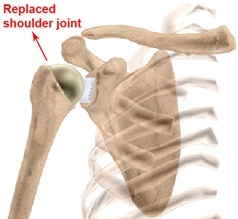 Replaced shoulder joint